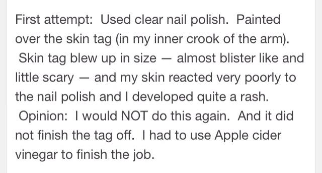 How To Remove Skin Tags With One Simple Ingredient1