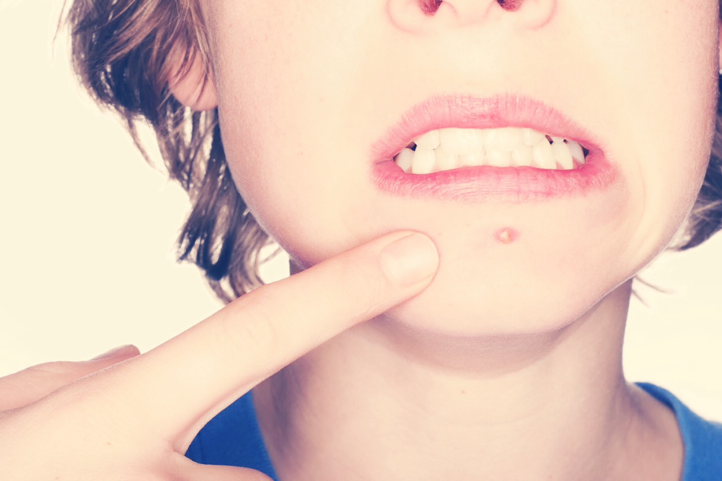 How To Get Rid Of Acne 
