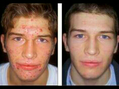 hate acne ? Don't you just hate those blemishes? itworks products will do just the work