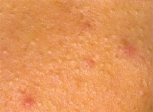 Whiteheads

Whiteheads are very similar to blackheads in that they are formed in almost exactly the same way except that dead skin cells not only block the pore, but they also form a layer over the top of it, covering the opening completely.
