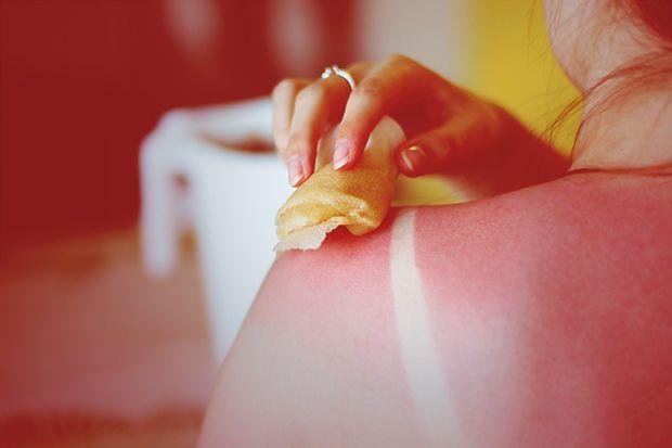 9.Using apple cider vinegar to treat sunburn.
Apple cider vinegar is widely praised for being antimicrobial and is included in a ton of DIY skin care remedies. Applying it to burned skin, however, is extremely risky and runs the risk of burning the skin further, especially if not diluted properly.