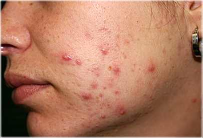 DERMATOLOGICAL CONDITIONS: adding one cup of baking soda to bathwater helps soothe itchiness and irritation. paste made of baking soda mixed with a little water and dabbed on sunburn, insect bites, allergic rashes, and skin exposed to poison oak/ivy reduces discomfort.