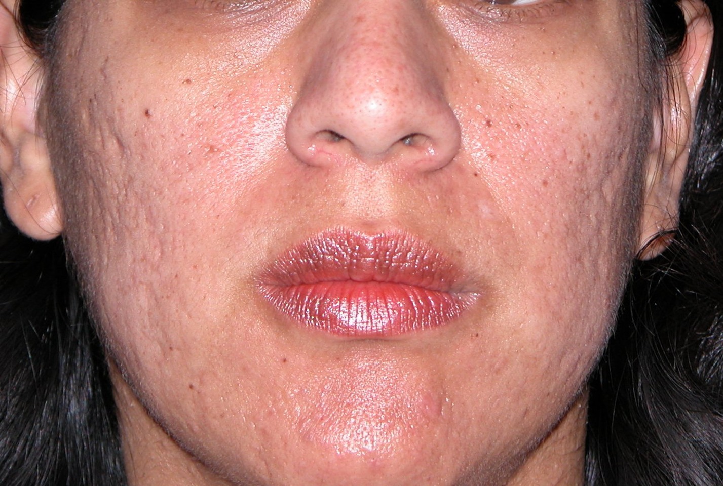 Do You Have unwanted Freckles, Acne Or Acne scares, Age Spots, Or Just Want Better, Softer Skin? 