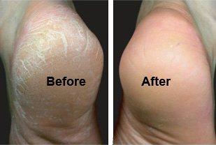 Cracked heels tend to worsen during the dry winter weather. This easy-to-prepare vinegar foot soaking solution will take care of that concern right away. You will need: