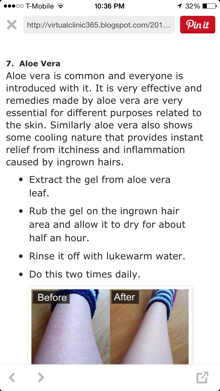 How To Get Rid Of Ingrown Hair! 