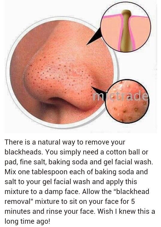 I personally have lot of black heads after trying this i hardly have any.!
Must try this😍