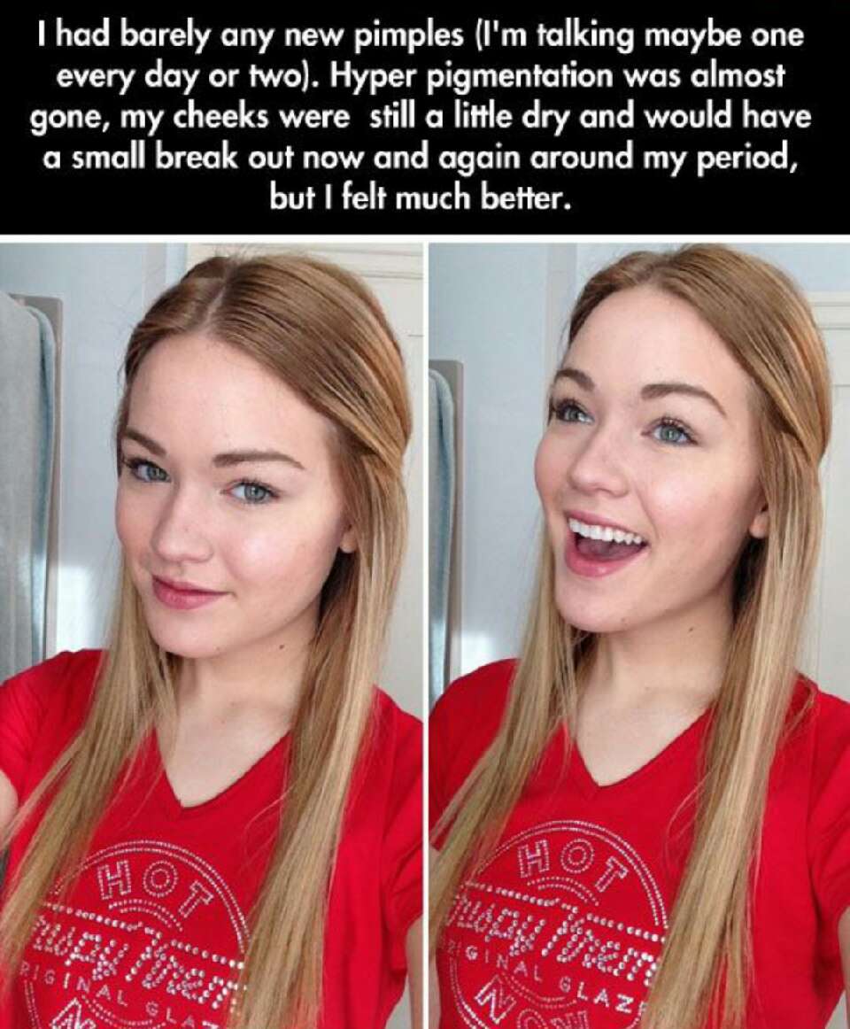 Natural Acne Prevention/ Treatment, bye bye Antibiotics! 