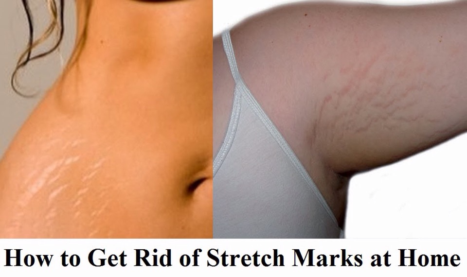 Next take someone's house squeezed lemons NO lemon juice fresh squeezed lemons and your favorite moisturizer and apply it to your stretch marks .