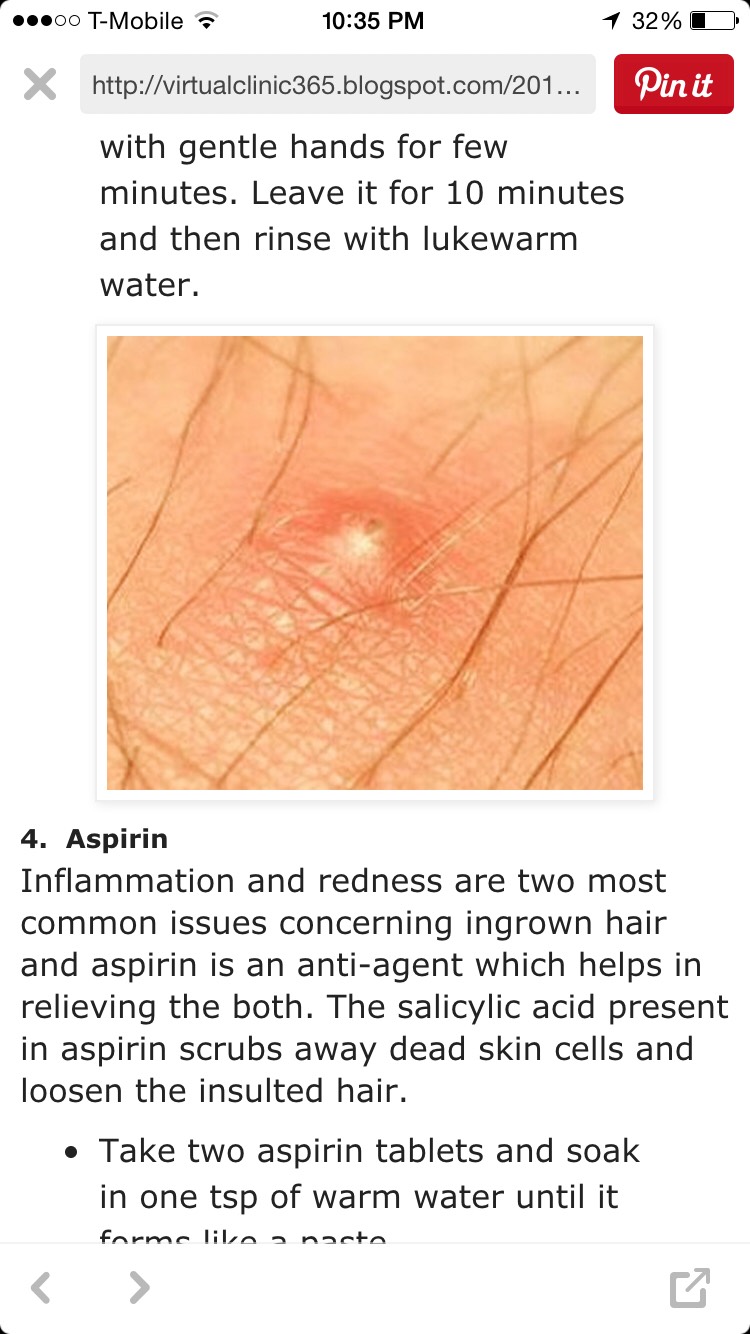 How To Get Rid Of Ingrown Hair! 