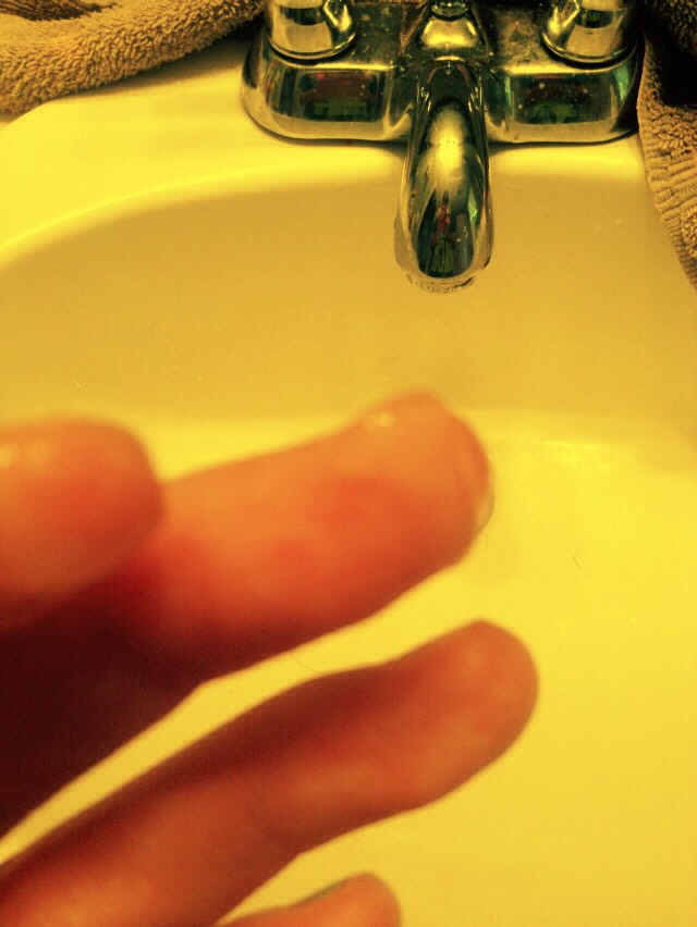 (It's on my finger😂) Apply the hand sanitizer to the effected area and wait for it to dry
