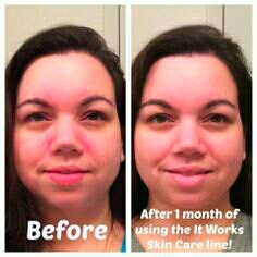hate acne ? Don't you just hate those blemishes? itworks products will do just the work