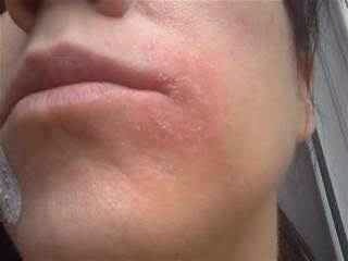 Eczema: apply to effected area for 20 minutes. Honey'a calming properties sooth the skin 