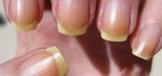 Top 10 natural remedies for yellow nails