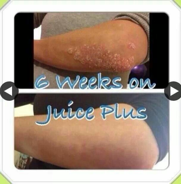 do you suffer from a skin condition? acne? Psoriasis?  dry skin?