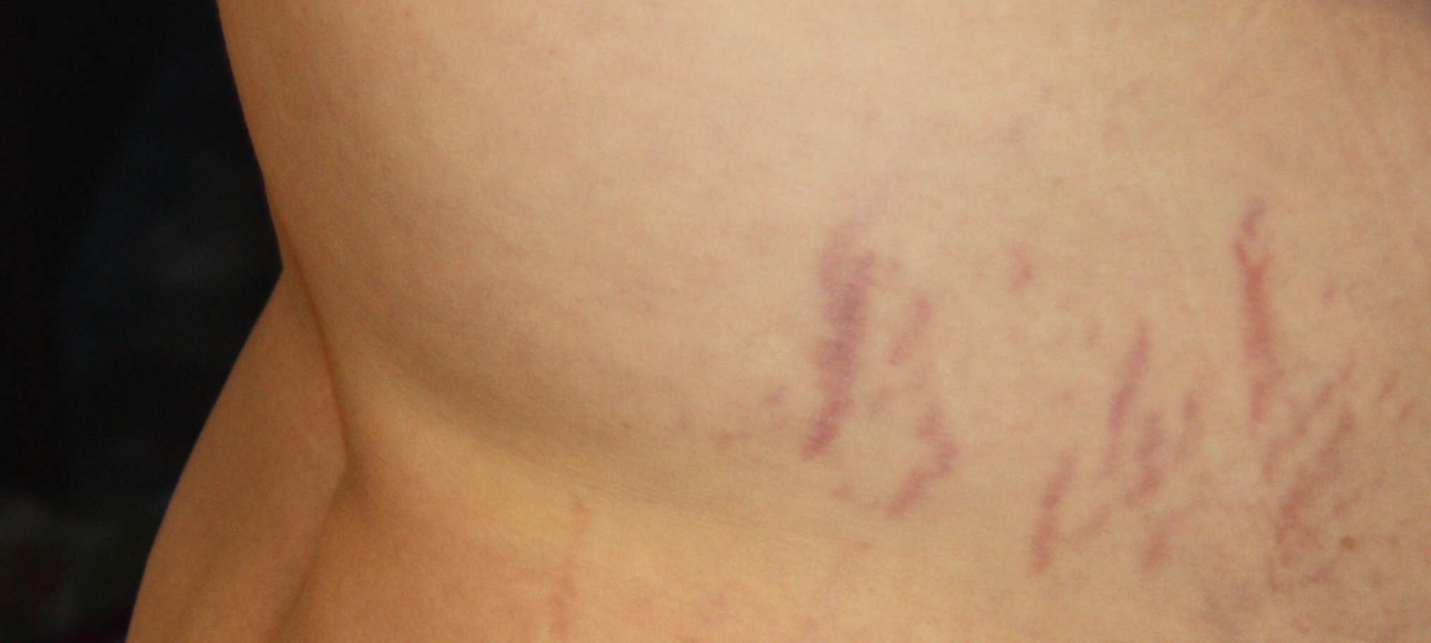 It reduces stretchmarks