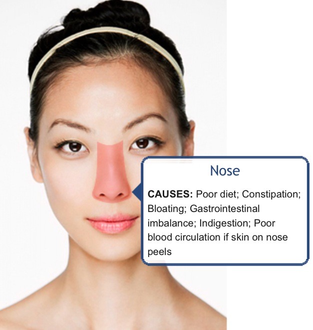 Face Mapping (Acne) - What Is Your Acne Telling You? 