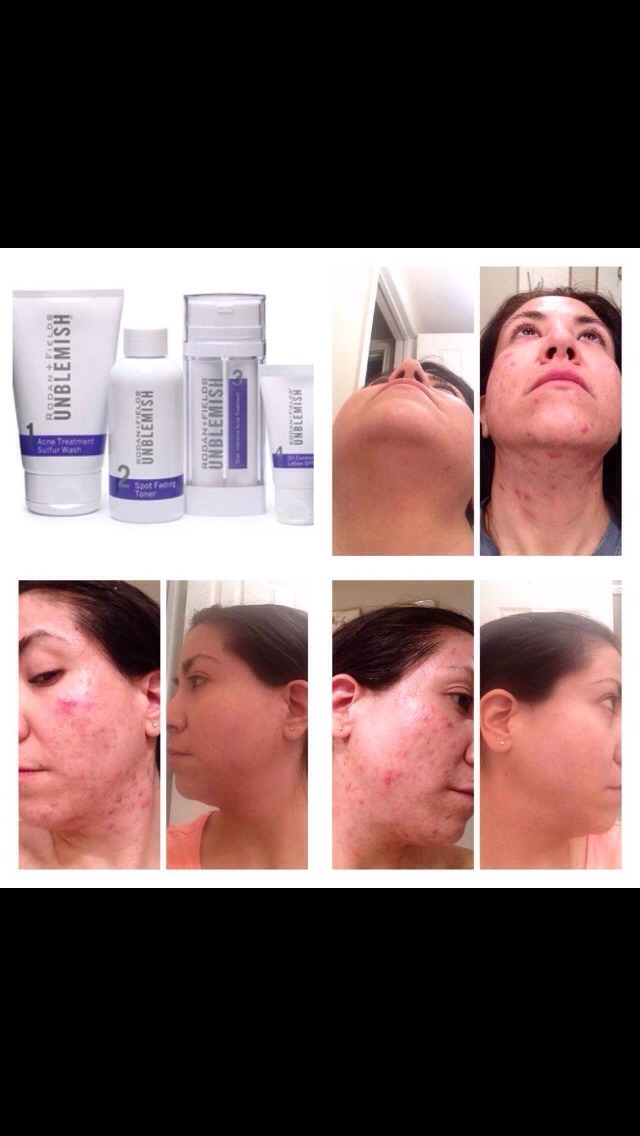 Using Unblemish for 2 months and look at these amazing results!!