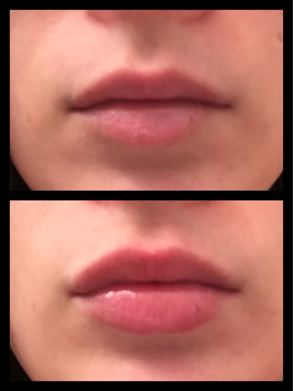 Before and after using Fullips enhancers