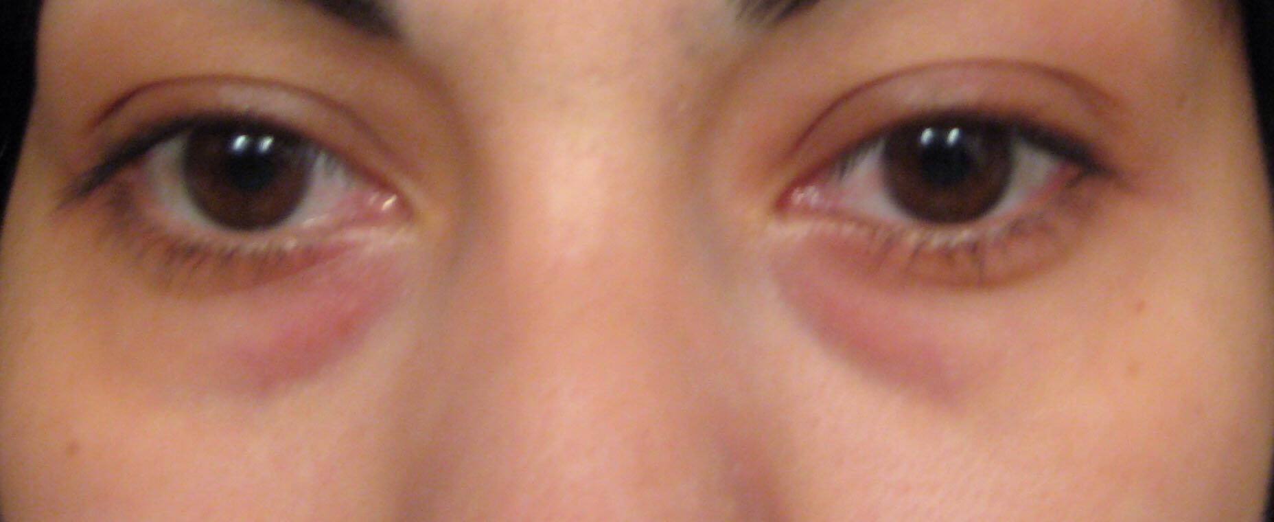 Dark Circles Remedy