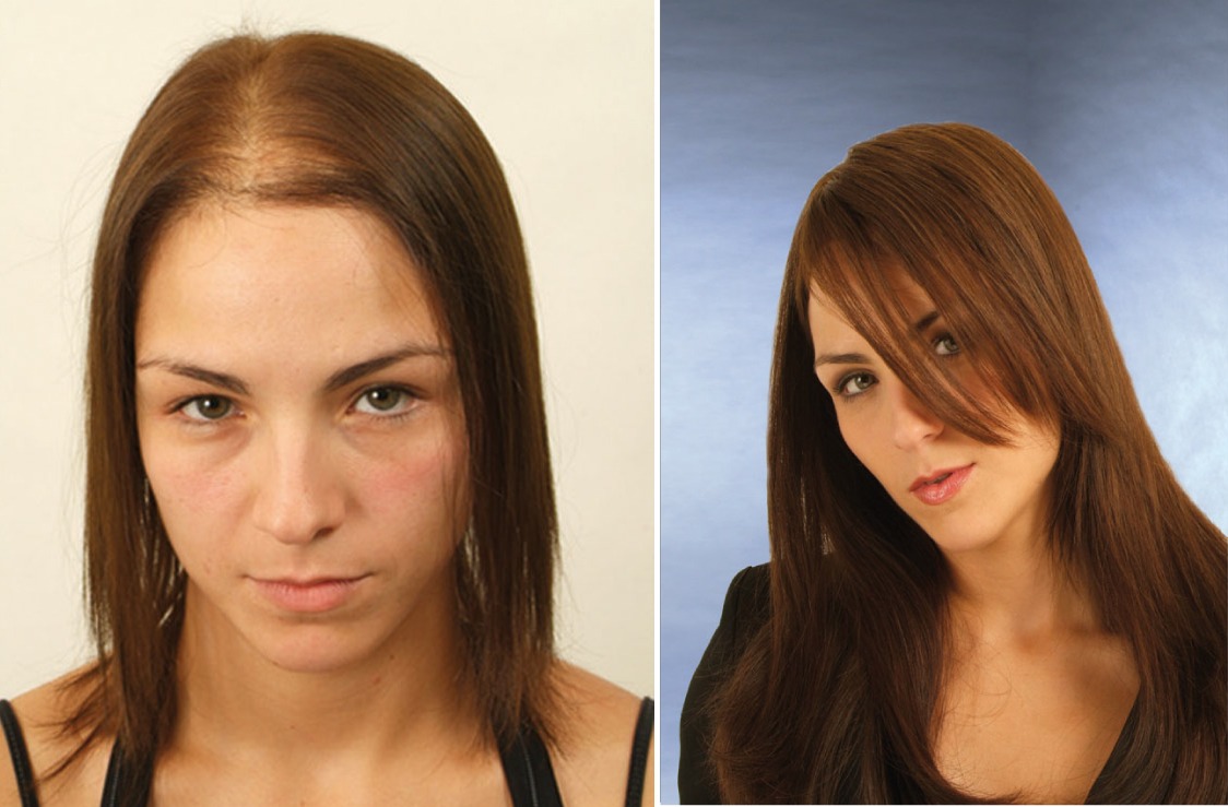 Hair Loss Treatment 