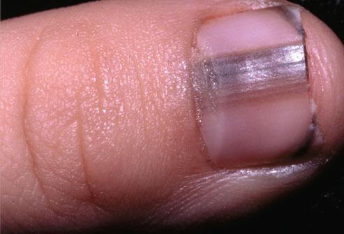 Dark Lines Beneath the Nail
Dark lines beneath the nail should be investigated as soon as possible. They are sometimes caused by melanoma, the most dangerous type of skin cancer.