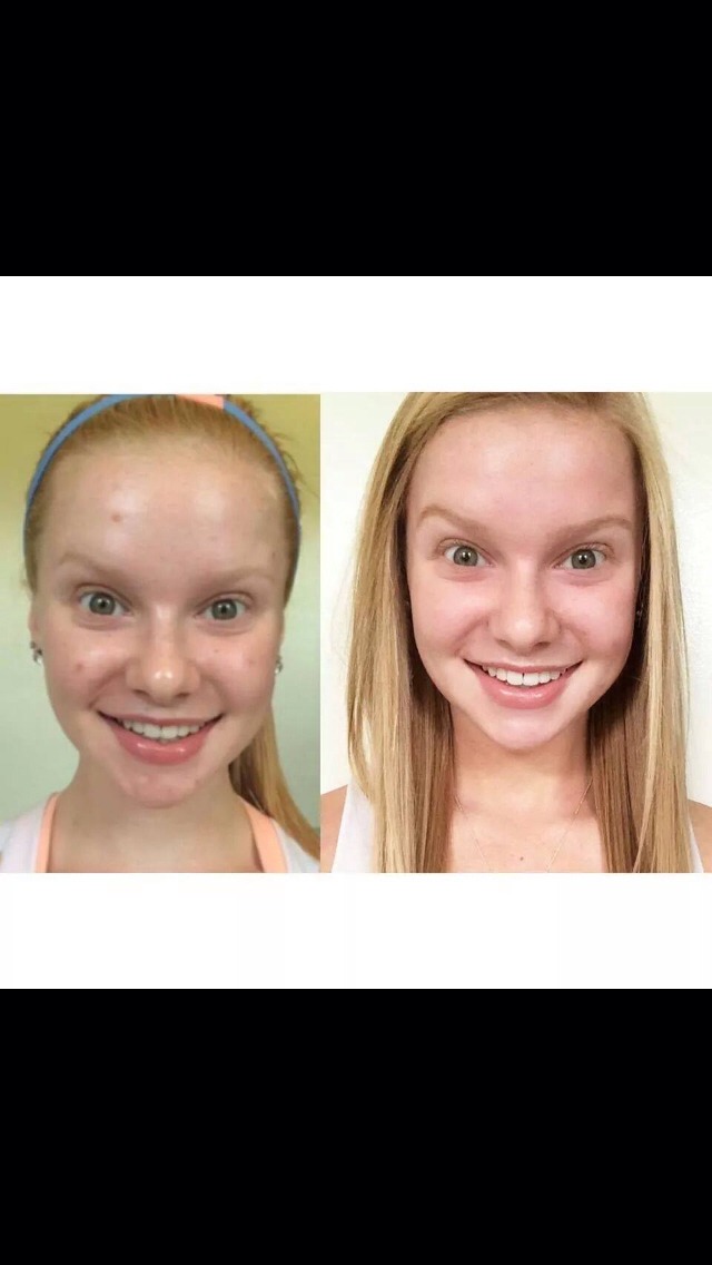 This is Brandi, a fellow consultant's daughter, and these are her results of using Unblemish for 2 months! Brandi is all smiles because she is going to start the school year with clear skin!