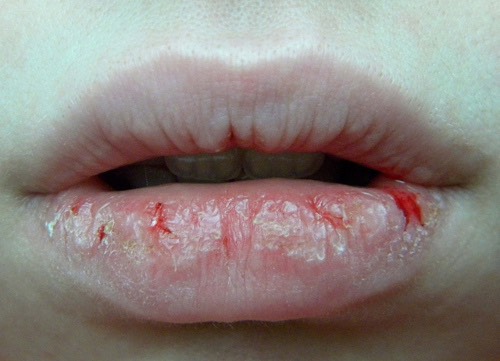 If your lips tend to get a little...broken.. You need a softener. While you can't use the Smooth Talker Water Peel while your lips are broken, you can use it before or after to prevent this from happening ever again.
