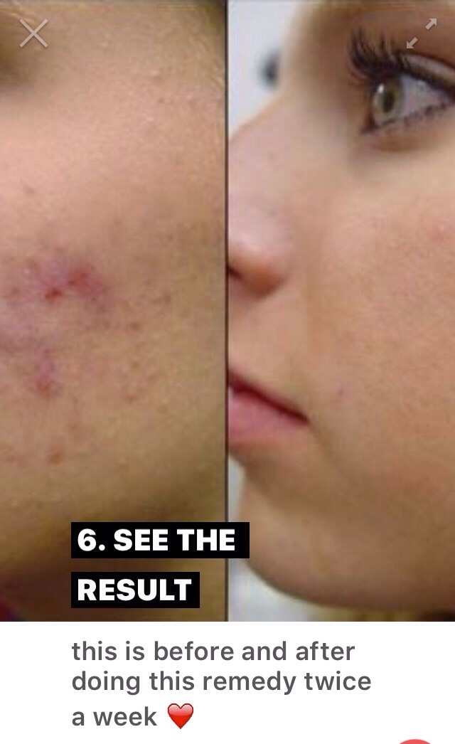 HOME REMEDY FOR ACNE FREE, GLOWING SKIN! 