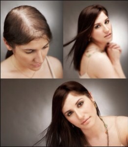 Natural Hair Loss Treatment