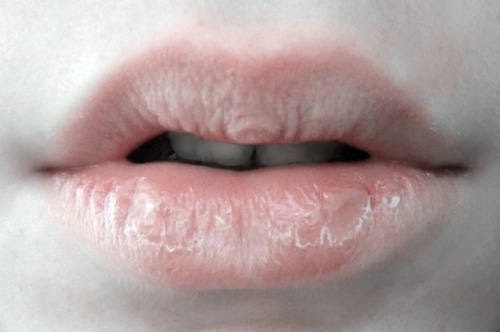 3. Another thing you could to is run the Vaseline over your lips every night if they are dry/cracked.