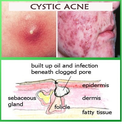 Acne is a horrible horrible curse that most of us females (and males) know a whole lot about. Trust me, I've struggled with acne for years! But I'm all cleared up and I'll share my little secret with you just keep an open mind and try new things