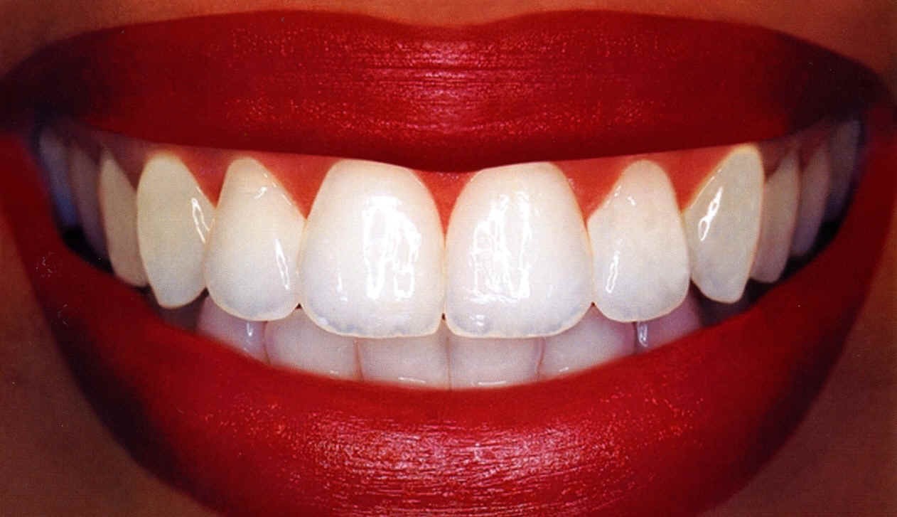 HOW TO GET CELEBRITY WHITE TEETH😘😬