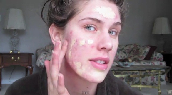 Tired of covering up your face and making everything worse, but you just cant go out with all those red dots on your face?