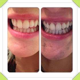 Natural Teeth Whitening😁✨👌
