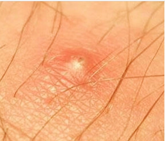 GETRID OF IN GROWN HAIRS LIKE RAZOR BUMPS OR SKIN PIMPLE 
