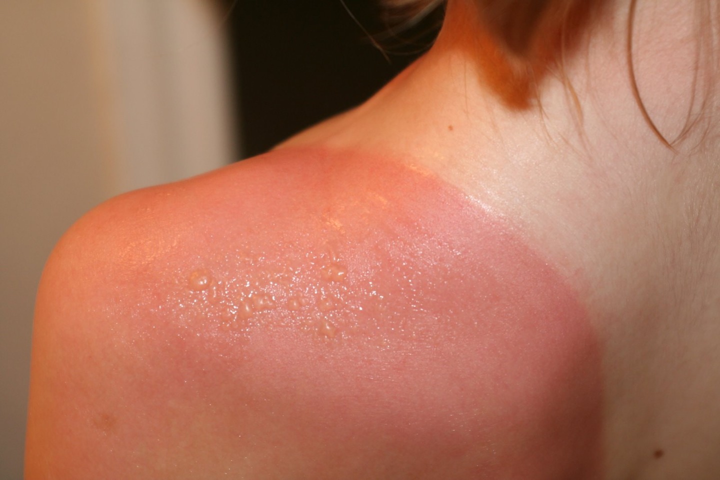 Aloé Vera Sunburn Relief Patches (Quick Easy And Home Made)