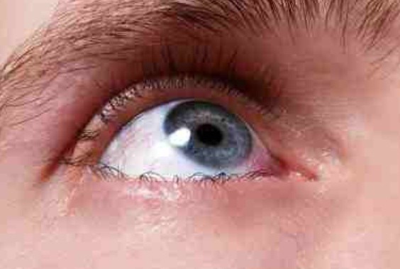 8. Tea Bags
It doesn’t matter what kind you use—black tea, white tea, or green tea—the quick relief for sunburned eyelids a cool tea bag applied to each swollen eye. The tannic acid within will ease swelling and reduce pain.


