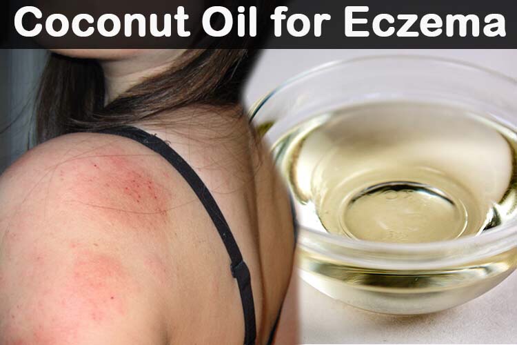 6. Rash and Burn Cream. Coconut oil helps to sooth rashes and burns. A small dab of coconut oil has always helped to reduce and even eliminate diaper rash.
