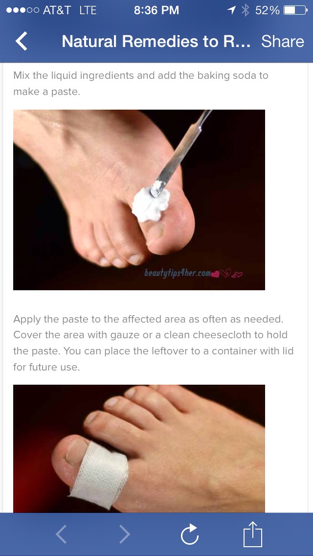 Natural Remedies to Remove Corn and Calluses – This Really Works

