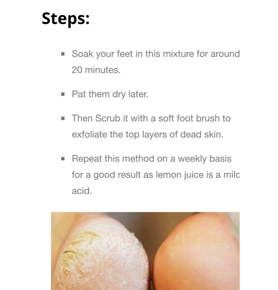 Diy Home Solution To Dry Scaly Cracked Heels 👣👣👍👍