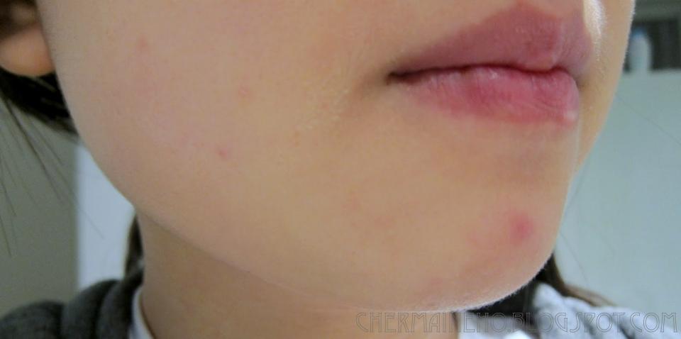 Side of chin. The sides of your chin are affected by hormones. Breakouts here occur around the time of your period and happen on one side or another depending on which ovary is ovulating that month.