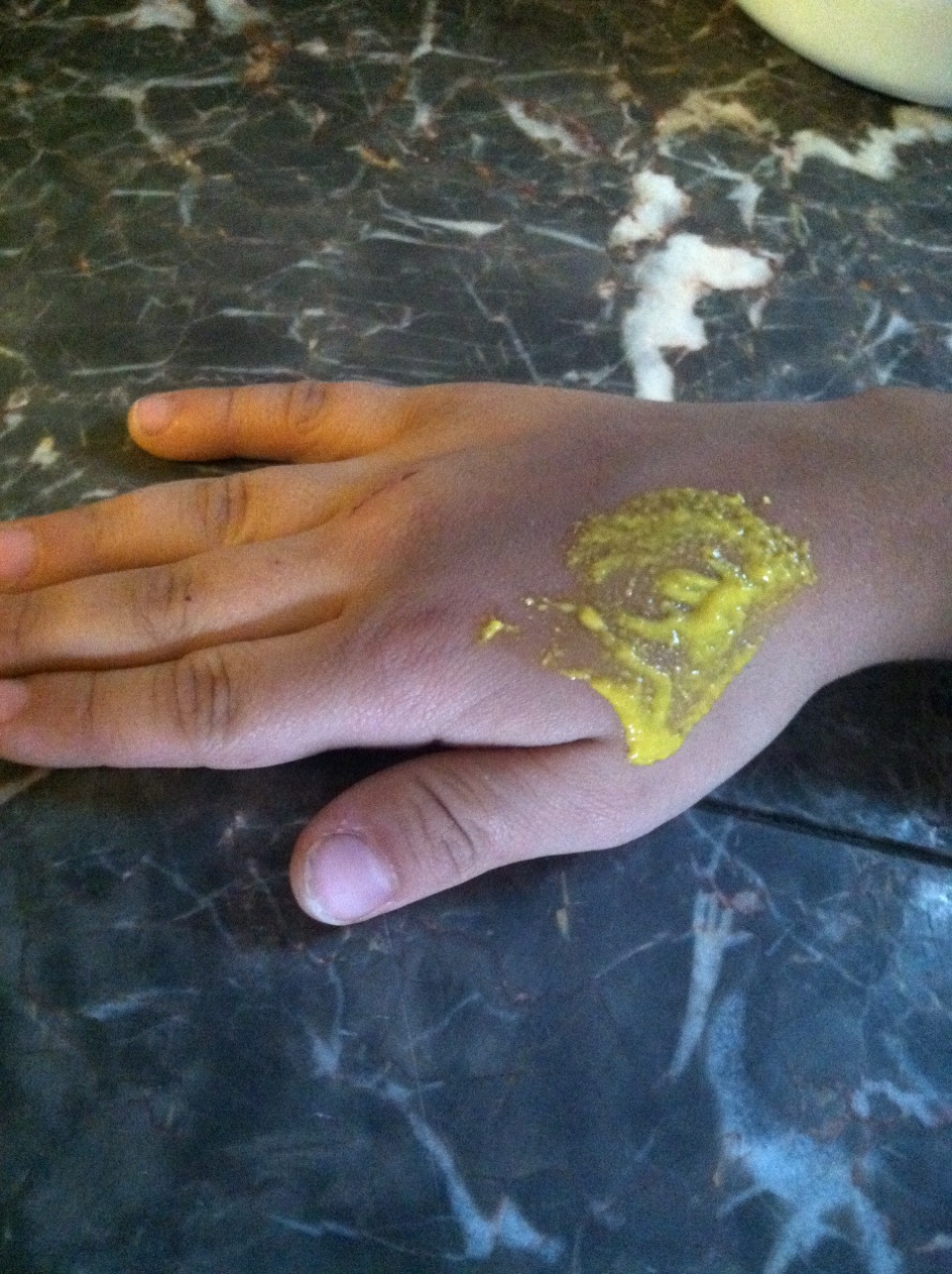The Best Way To Recover From Burning Your Skin,Try This