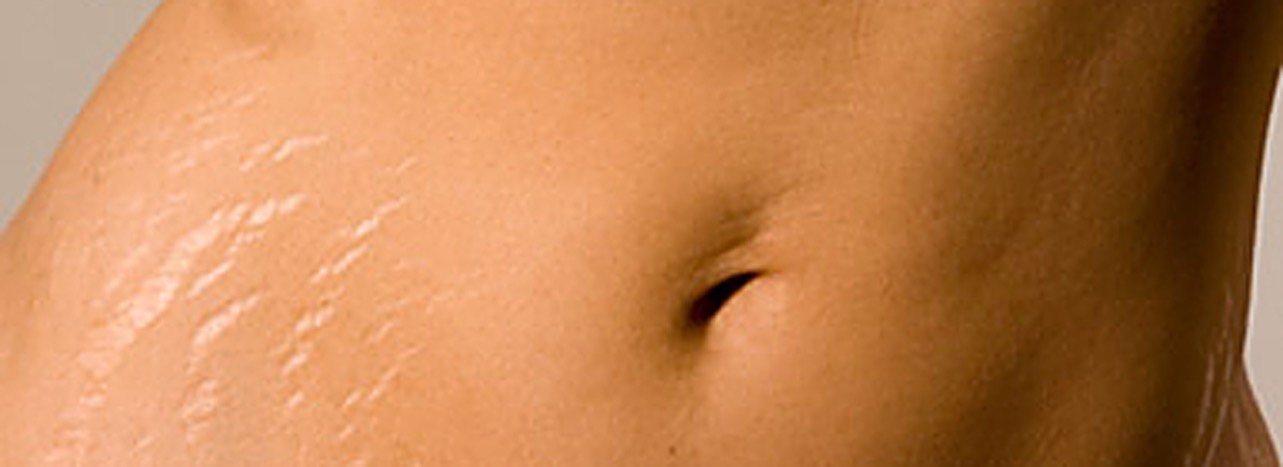 I always see DIY stretch mark removers with different natural oils in them BUT... ➡️➡️