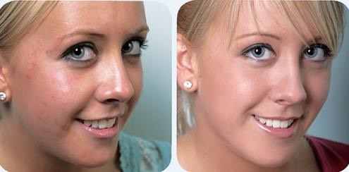 Your skin will become less oily, the breakouts will disappear, and acne scars will vanish!!!