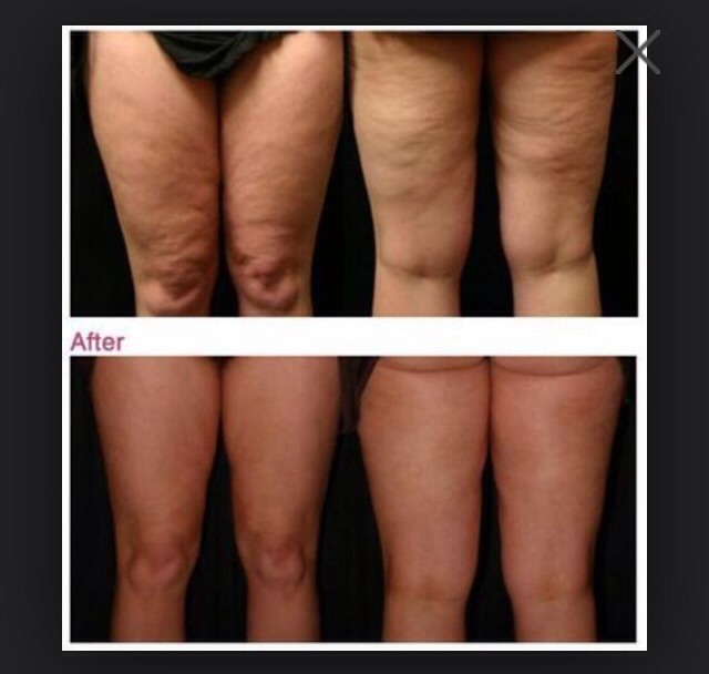 Need To Tighten Tone And Firm Your Body?Have Ugly Stretch Marks?Cellulite? Here's The Cure Email Me 
