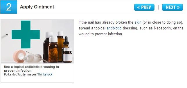 10 Home Remedy For Ingrown Nails