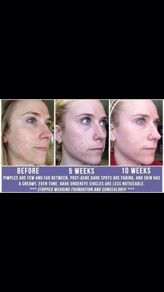 10 weeks using Unblemish and now this young lady doesn't even have to wear makeup!!