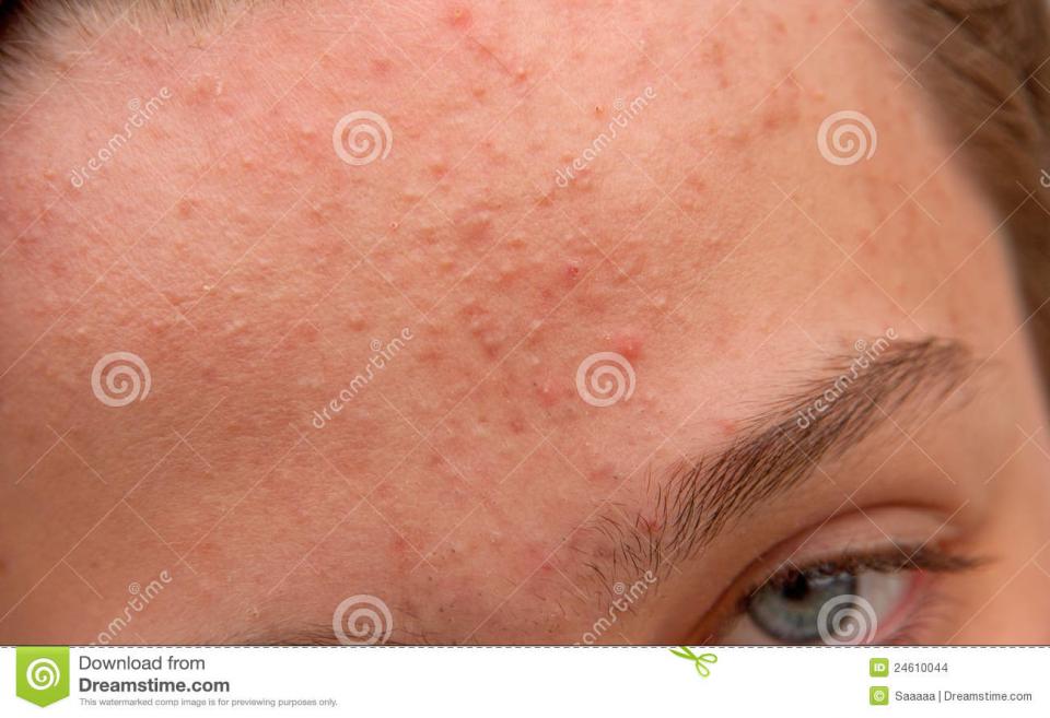 Forehead. Breakouts across the forehead are often triggered by stress or sleep deprivation. Make sure to log 7 to 9 hours of beauty rest a night to keep your forehead clear.