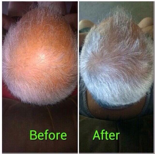 Easy Way To Grow Hair Back Fast