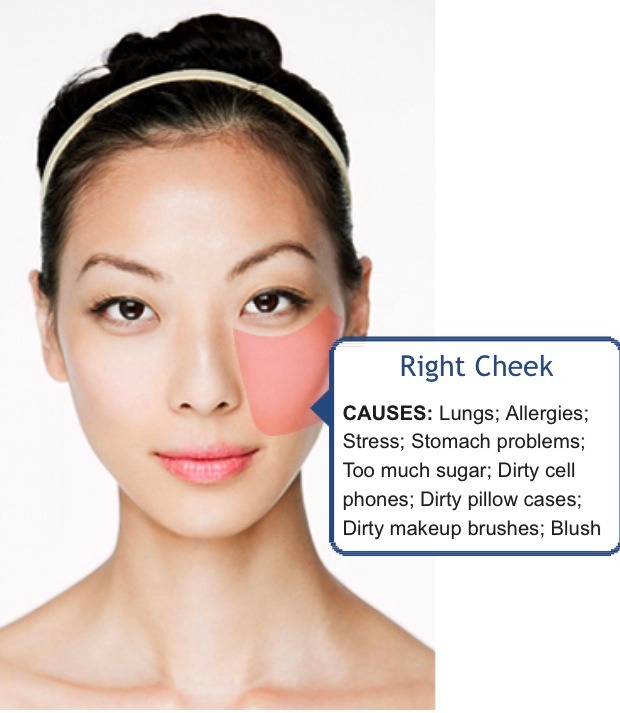 Face Mapping (Acne) - What Is Your Acne Telling You? 